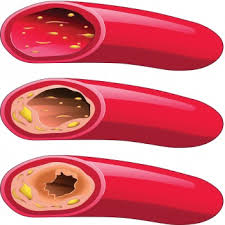 Revoluční léčba vysokého cholesterolu Revoluční léčba vysokého cholesterolu